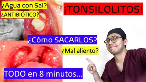 síntomas de tonsilolito